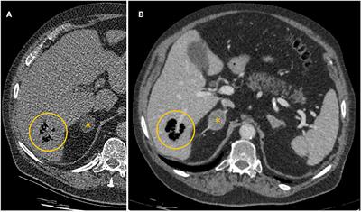 First successful treatment of Clostridium perfringens-associated emphysematous hepatitis: a case report